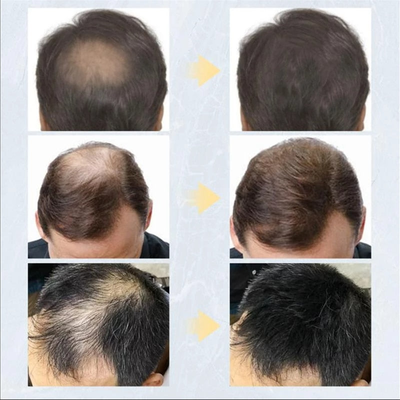 Queratina em pó Para Falhas no Cabelo  - TOPHAIR®