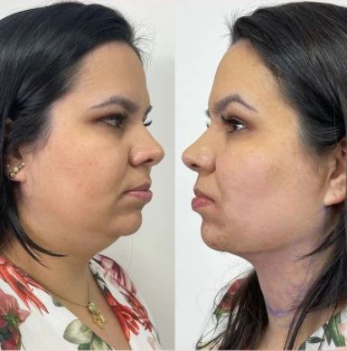 Redutor de Gordura Facial - FaceLift™