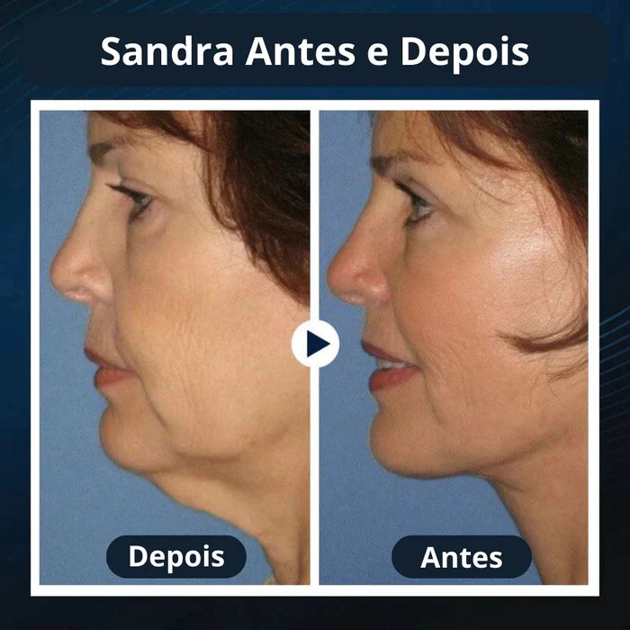 Redutor de Gordura Facial - FaceLift™