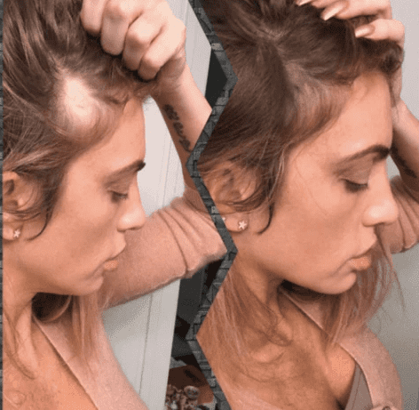 Queratina em pó Para Falhas no Cabelo  - TOPHAIR®